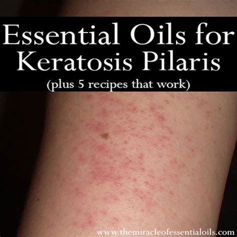 6 Essential Oils For Keratosis Pilaris With 5 Recipes To Use The