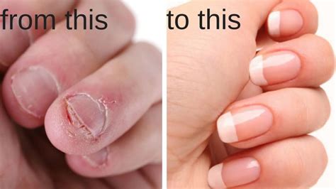 How To Identify What Is Nail Biting A Symptom Of