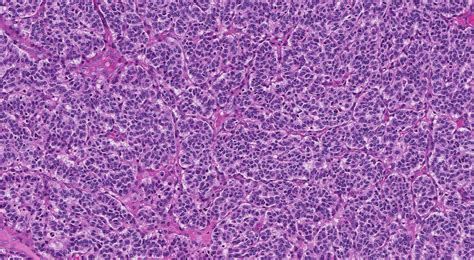 Typical Carcinoid Tumour Of The Lung Mypathologyreportca