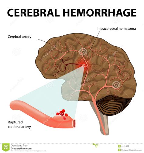 È causata dalla rottura di un'emorragia cerebrale è etichettata a seconda del punto dove si verifica: Emorragia cerebrale illustrazione vettoriale ...