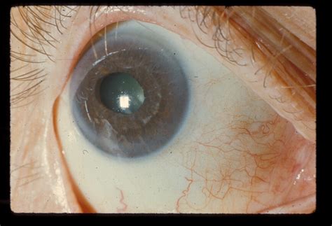 Axenfeld Rieger Syndrome Type 1 Hereditary Ocular Diseases