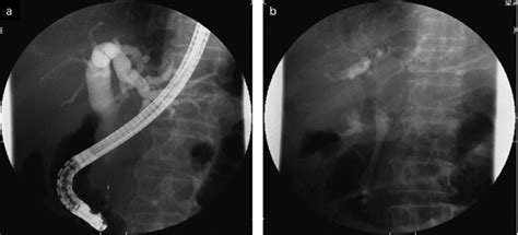 A Ercp Revealed An Obstruction At The Distal Portion Of The Cbd B A