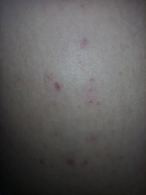 What Are These Red Dots On My Thigh Rdermatology
