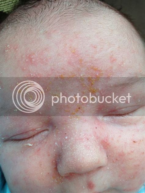 Baby Acne Now With Yellow Crust Babycenter