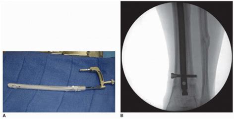 Tibial Shaft Fractures Intramedullary Nailing Musculoskeletal Key