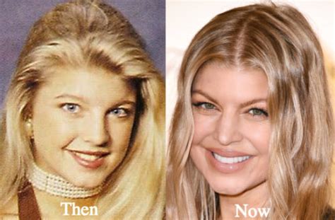 Fergie Plastic Surgery Before And After Photos