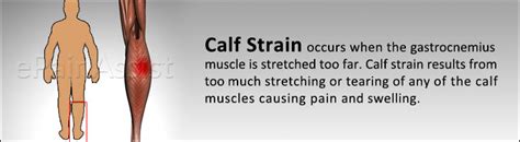 Calf Straintreatmentsymptomsrecoverycausesprognosis