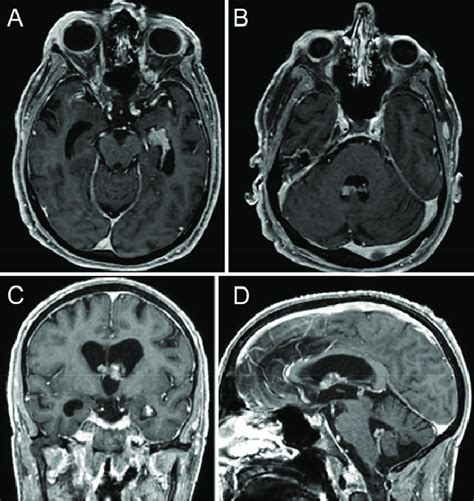 Repeat Preoperative T1 Weighted Postcontrast Mri Showing Progression Of