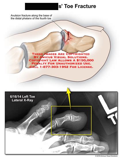 Amicus Illustration Of Amicusinjuryradiologyx Raytoefracture