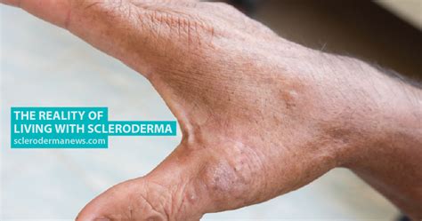 The Reality Of Living With Scleroderma Scleroderma News