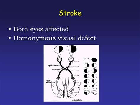 Ppt Back To Basics Ophthalmology Acute Visual Disturbanceloss