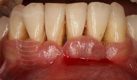 Generalized periodontitis as a local because the damaged tissue only the periodontal, the symptoms are more pronounced, and the reasons for his domestic and. Acute Ulcerative Necrotizing Periodontitis (ANUP) | Spyros ...