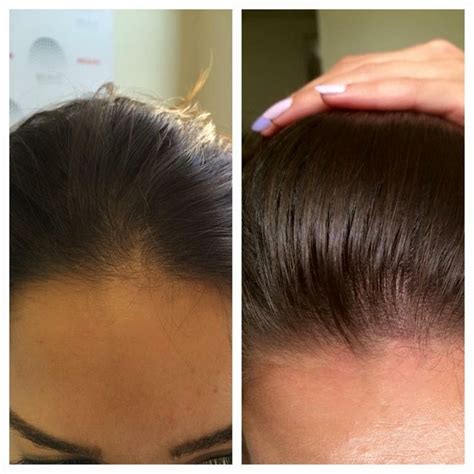 Pin on scalp micro