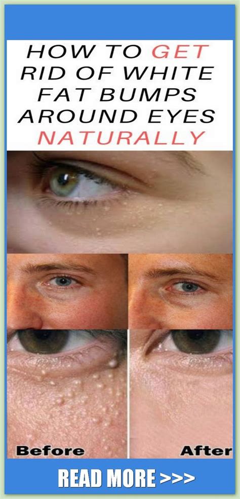 How To Get Rid Of White Fat Bumps Around Eyes Naturally Health Goals
