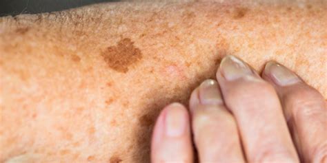 How To Differentiate Harmless Sunspots From Skin Cancer Name Group