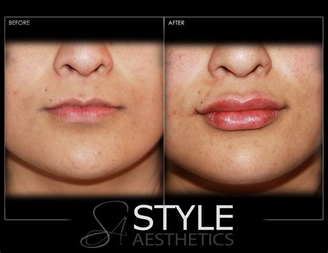 Lip Augmentation Style Aesthetics