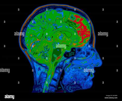 Ea70r9 Mri Image Of Head Showing Brain Hi Res Stock Photography And