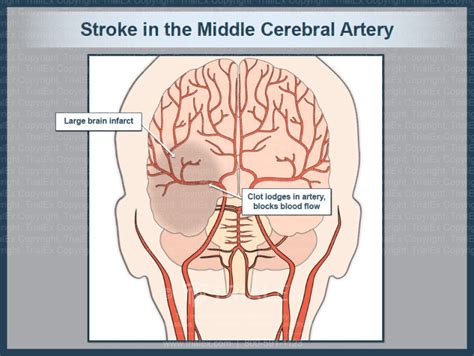 Stroke In The Middle Cerebral Artery Trial Exhibits Inc