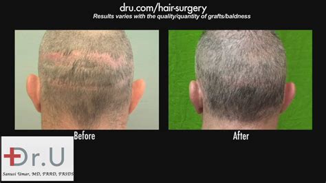 Video Hair Transplant Scar Revision Before And After Drugraft