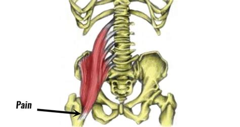 Iliopsoas Bursitis And Inflammation Symptoms Causes And Rehabilitation