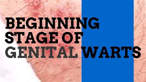 stages of genital warts