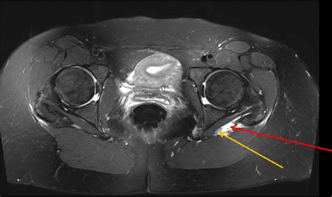 Piriformis Syndrome As A Result Of Intramuscular Haematoma Mimicking