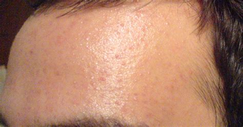 Pimples Only On Forehead Adult Acne Community