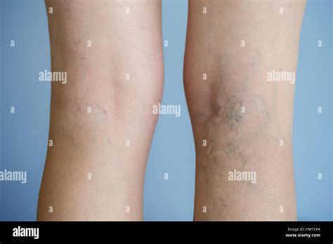 Painful Varicose Veins Spider Veins Varices On A Severely Affected