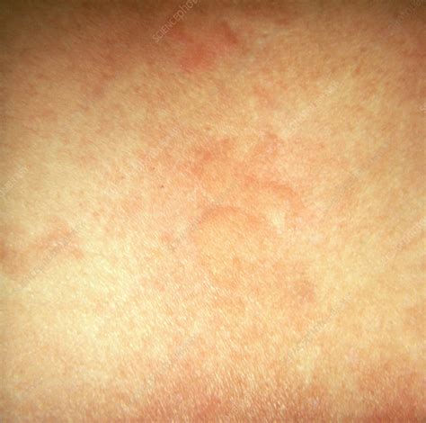 Urticaria Rash Stock Image C0222142 Science Photo Library