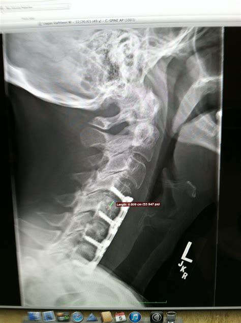 My X Ray From Acdf Surgery Done On 21313 Three Discs Replaced C4