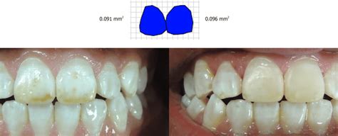 Total Surface Of A Fluorosis Stained Tooth With A Medium Sized Stain