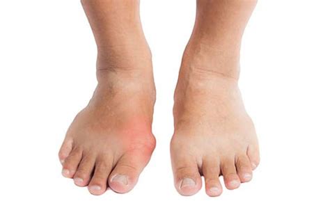 Gout Burbank Podiatrist Los Angeles Foot And Ankle Center