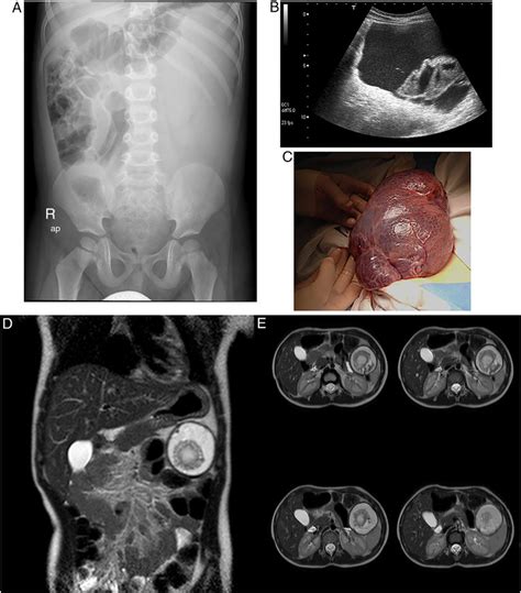 A C Radiological And Surgical Findings In Case A A Abdominal