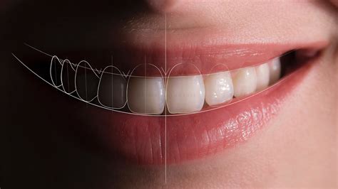 Diseño De Sonrisa Para Odontólogos Dr Jaime Guinovart