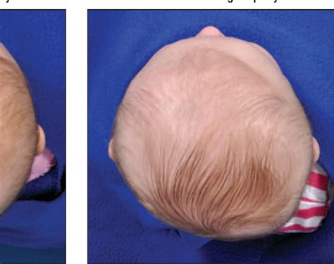Figure 3 From Deformational Plagiocephaly A Review Semantic Scholar