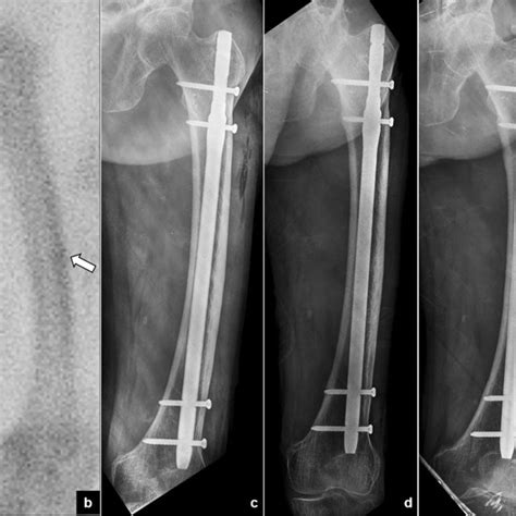 A Distal Diaphyseal Femoral Fracture Treated With Retrograde