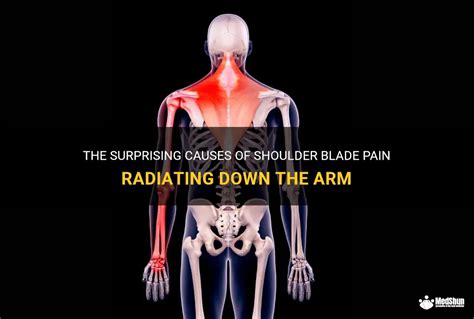 The Surprising Causes Of Shoulder Blade Pain Radiating Down The Arm