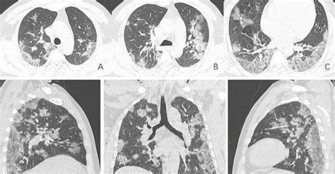 Ct Scans And X Rays Display The Damage To The Lungs Of Covid 19 Patients