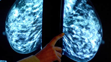 artificial intelligence outperforms radiologists in detecting breast cancer oye times