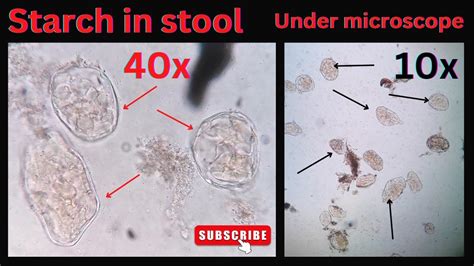 Starch Under Microscope Starch In Stool Starch Granules
