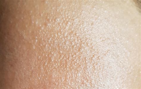 Skin Concerns Tiny Flesh Colored Bumps On Face Rskincareaddiction
