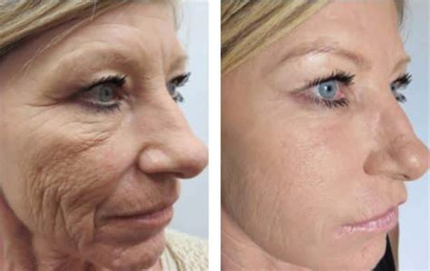 What Are The Benefits Of Vivace Rf Microneedling New York City