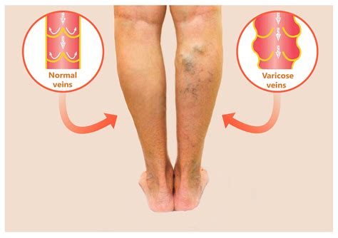 How To Get Rid Of Unsightly Hand And Leg Veins — Vein Institute