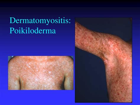 Ppt Dermatomyositis Muscle Histology Powerpoint Presentation Free