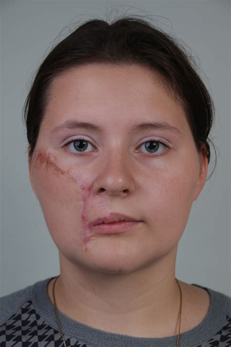 A Case Report Of A Proactive Approach To Perioral Reconstruction After