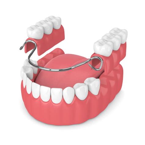 Partial Dentures Frisco Tx Front Or Back Teeth Highland Oak Dental