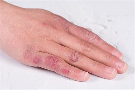 Relationship Between Covid 19 And Chilblains