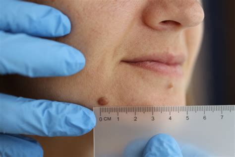 Moles Skin Tags And Warts Removal Treatment For A Flawless Skin