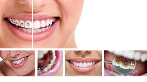Options When It Comes To Braces For Adults