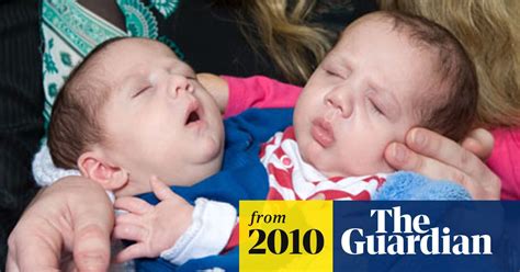 Four Month Old Conjoined Twins Having Separation Surgery Health The
